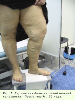 Na zastavenie procesu je potrebné liečiť kŕčové žily