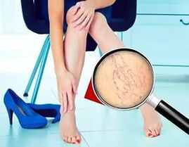 Príznaky závisia od povahy a štádia kŕčových žíl