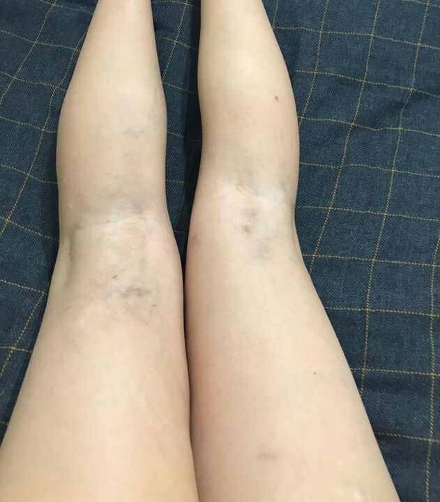 prejavy kŕčových žíl na nohách